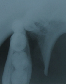 oblique fracture mandible