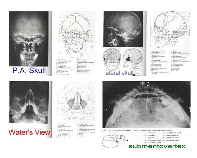 Oral Maxillofacial surgery: Diagnosis Image Facial Fracture