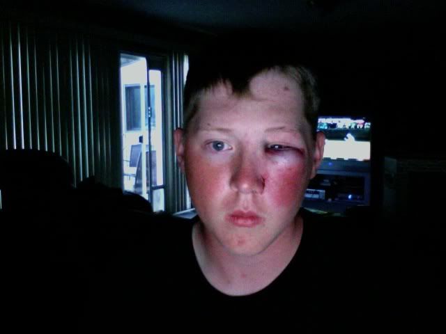 Got hit with a baseball - See this image on Photobucket.